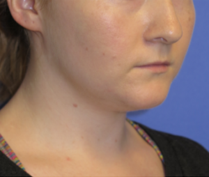 Neck Lipo Case 6251 Before Photo Neck Lipo
