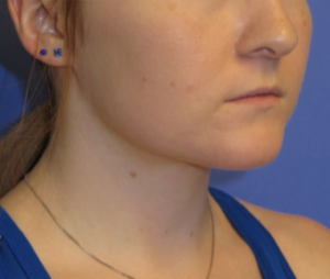 Neck Lipo Case 6251 After Photo Neck Lipo
