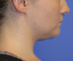 Neck Lipo