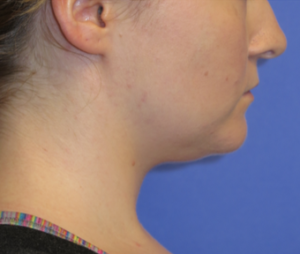 Neck Lipo Case 6251 Before Photo Neck Lipo