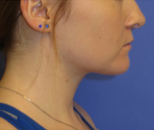 Neck Lipo Case 6251 After Photo Neck Lipo