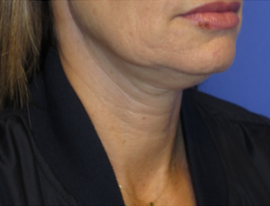 FACEology Lift / Neck Lift Case 6272 Before Photo FACEology Lift / Neck Lift