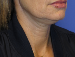 FACEology Lift / Neck Lift