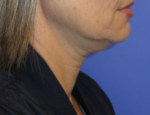 FACEology Lift / Neck Lift