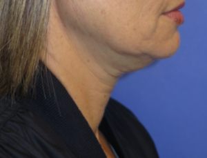 FACEology Lift / Neck Lift Case 6272 Before Photo FACEology Lift / Neck Lift