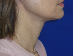 FACEology Lift / Neck Lift Case 6272 After Photo FACEology Lift / Neck Lift