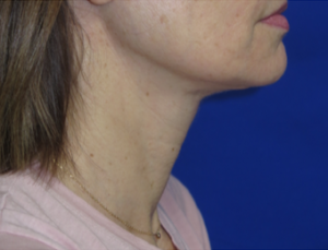 FACEology Lift / Neck Lift