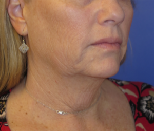 FACEology Lift / Neck Lift Case 6273 Before Photo FACEology Lift / Neck Lift