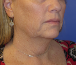 FACEology Lift / Neck Lift