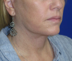 FACEology Lift / Neck Lift Case 6273 After Photo FACEology Lift / Neck Lift