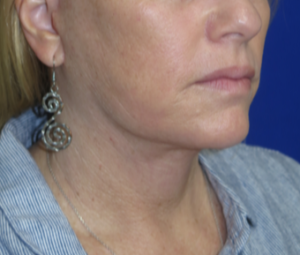 FACEology Lift / Neck Lift