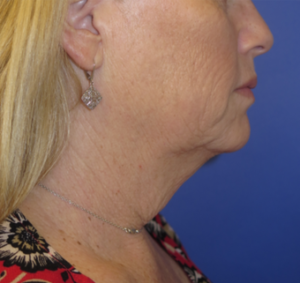 FACEology Lift / Neck Lift Case 6273 Before Photo FACEology Lift / Neck Lift