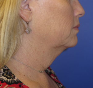 FACEology Lift / Neck Lift