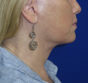 FACEology Lift / Neck Lift Case 6273 After Photo FACEology Lift / Neck Lift