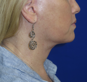 FACEology Lift / Neck Lift