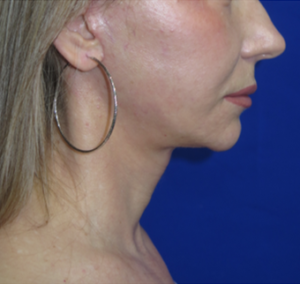 FACEology Lift / Neck Lift Case 6274 After Photo FACEology Lift / Neck Lift