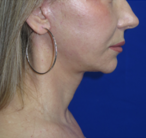 FACEology Lift / Neck Lift