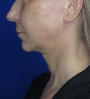 FACEology Lift / Neck Lift Case 6274 Before Photo FACEology Lift / Neck Lift