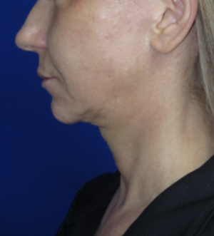 FACEology Lift / Neck Lift