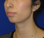 Chin Implant