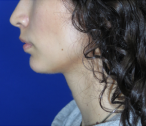 Chin Implant Case 6297 After Photo Chin Implant