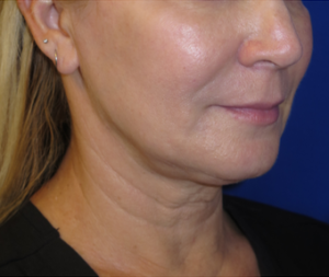 FACEology Lift / Neck Lift Case 6315 Before Photo FACEology Lift / Neck Lift