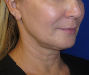 FACEology Lift / Neck Lift