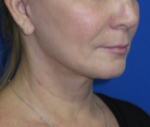 FACEology Lift / Neck Lift