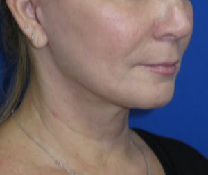 FACEology Lift / Neck Lift Case 6315 After Photo FACEology Lift / Neck Lift