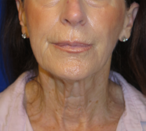 FACEology Lift / Neck Lift Case 6314 Before Photo FACEology Lift / Neck Lift