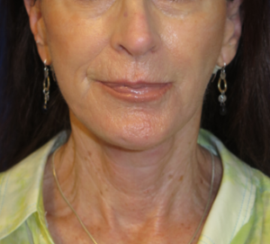 FACEology Lift / Neck Lift Case 6314 After Photo FACEology Lift / Neck Lift