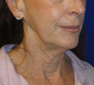FACEology Lift / Neck Lift Case 6314 Before Photo FACEology Lift / Neck Lift