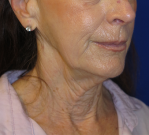 FACEology Lift / Neck Lift