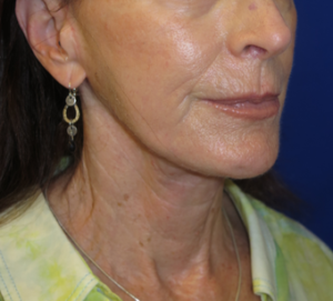 FACEology Lift / Neck Lift Case 6314 After Photo FACEology Lift / Neck Lift