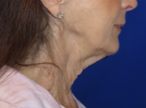 FACEology Lift / Neck Lift Case 6314 Before Photo FACEology Lift / Neck Lift