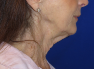 FACEology Lift / Neck Lift