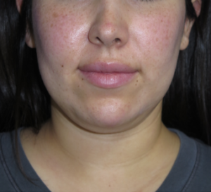 Neck Lipo Case 6313 Before Photo Neck Lipo
