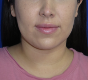 Neck Lipo Case 6313 After Photo Neck Lipo
