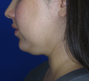 Neck Lipo Case 6313 Before Photo Neck Lipo