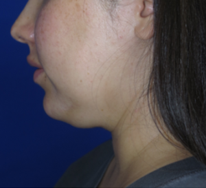 Neck Lipo