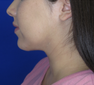 Neck Lipo Case 6313 After Photo Neck Lipo