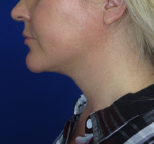 Neck Lipo Case 6328 After Photo Neck Lipo