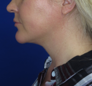 Neck Lipo