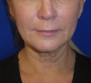 FACEology Lift / Neck Lift Case 6315 Before Photo FACEology Lift / Neck Lift