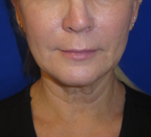 FACEology Lift / Neck Lift