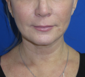 FACEology Lift / Neck Lift Case 6315 After Photo FACEology Lift / Neck Lift