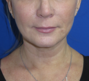 FACEology Lift / Neck Lift