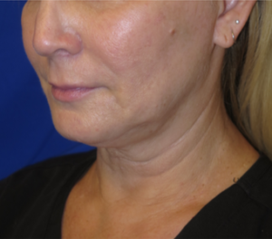 FACEology Lift / Neck Lift Case 6315 Before Photo FACEology Lift / Neck Lift