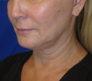 FACEology Lift / Neck Lift