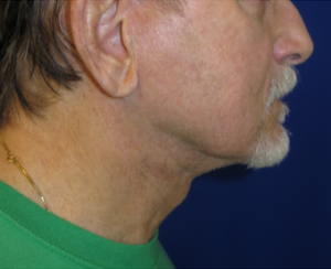 FACEology Lift / Neck Lift